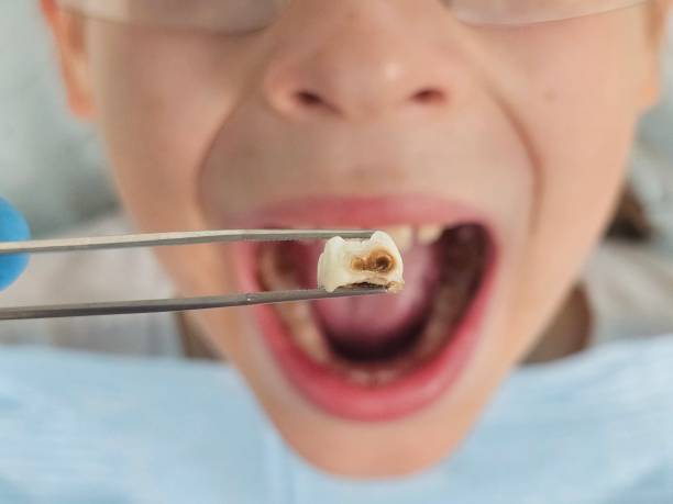 Best Emergency Dental Care for Broken or Chipped Teeth in Glendale, OH