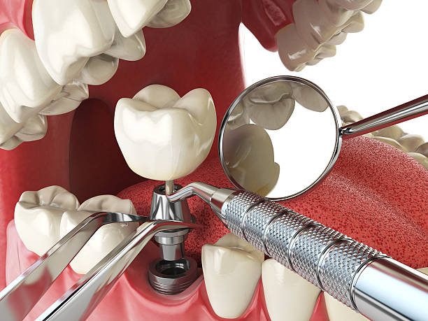 Best Emergency Treatment for Dental Infections or Abscesses in Glendale, OH